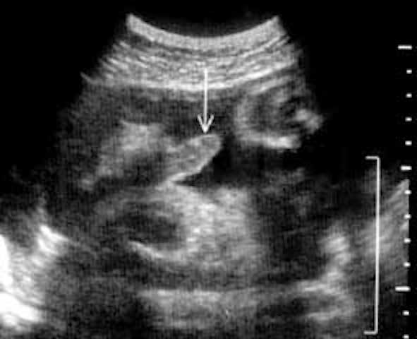 Échographie d'un pénis en érection chez un fœtus de 36 semaines